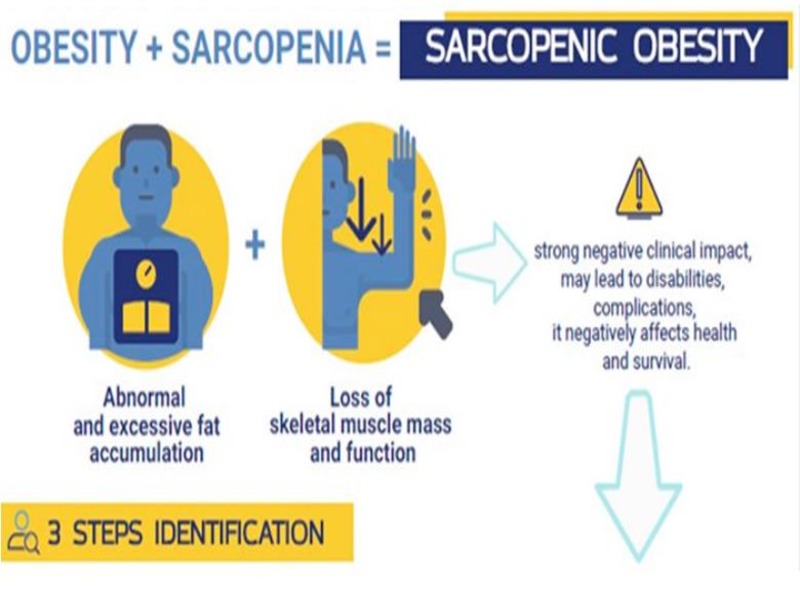 Obesidad sarcopénica y cáncer